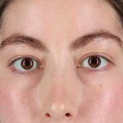 Blepharoplasty (Eyelid Surgery) Before & After Patient #4514