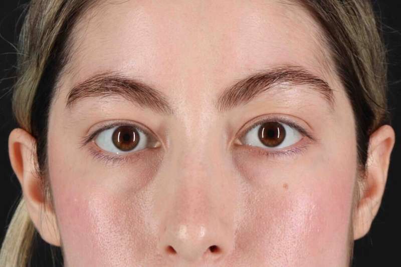 Blepharoplasty (Eyelid Surgery) Before & After Patient #4514