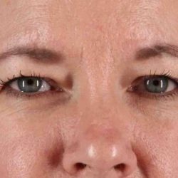 Blepharoplasty (Eyelid Surgery) Before & After Patient #4536