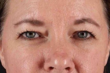 Blepharoplasty (Eyelid Surgery) Before & After Patient #4536