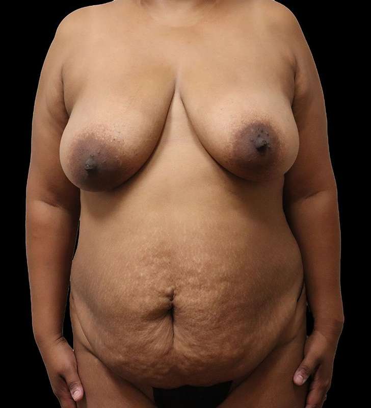 Abdominoplasty (Tummy Tuck) Before & After Patient #975