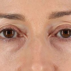 Blepharoplasty (Eyelid Surgery) Before & After Patient #4539