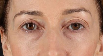 Blepharoplasty (Eyelid Surgery) Before & After Patient #4539