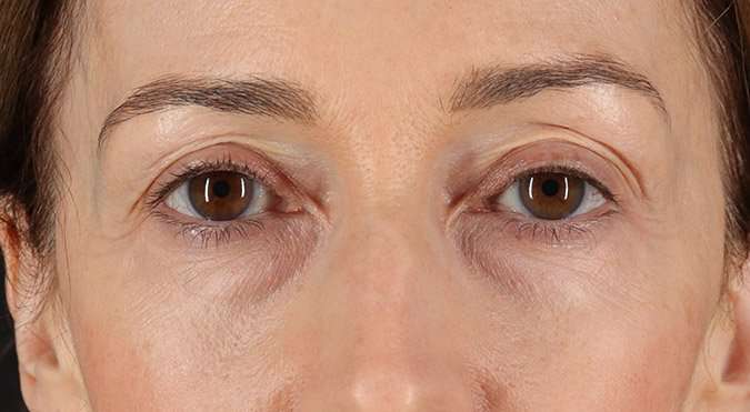 Blepharoplasty (Eyelid Surgery) Before & After Patient #4539