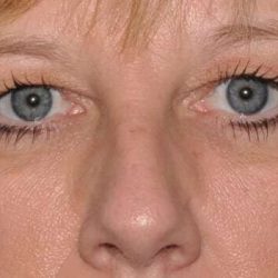 Blepharoplasty (Eyelid Surgery) Before & After Patient #4546