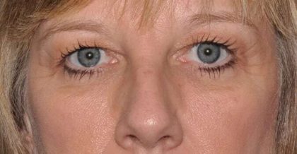 Blepharoplasty (Eyelid Surgery) Before & After Patient #4546