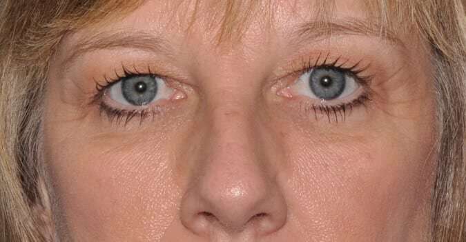 Blepharoplasty (Eyelid Surgery) Before & After Patient #4546