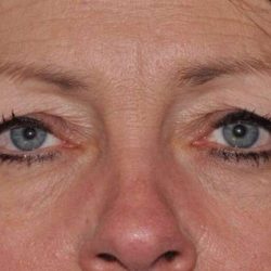 Blepharoplasty (Eyelid Surgery) Before & After Patient #4553
