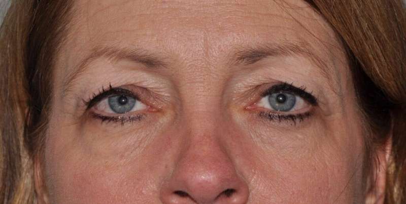 Blepharoplasty (Eyelid Surgery) Before & After Patient #4553