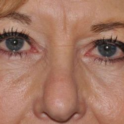 Blepharoplasty (Eyelid Surgery) Before & After Patient #4560