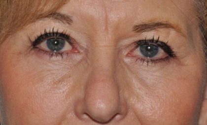 Blepharoplasty (Eyelid Surgery) Before & After Patient #4560