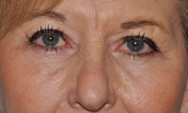 Blepharoplasty (Eyelid Surgery) Before & After Patient #4560