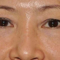 Blepharoplasty (Eyelid Surgery) Before & After Patient #4567