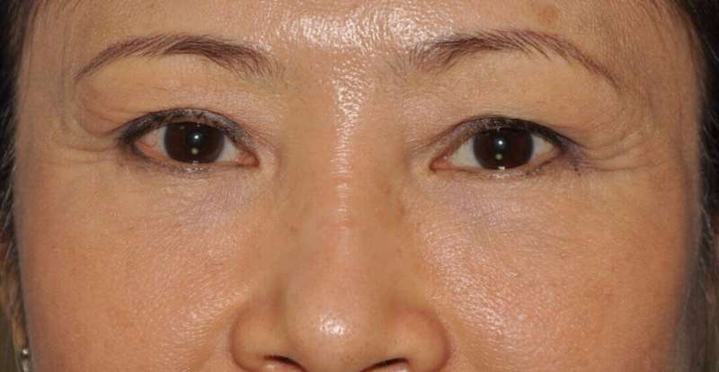 Blepharoplasty (Eyelid Surgery) Before & After Patient #4567