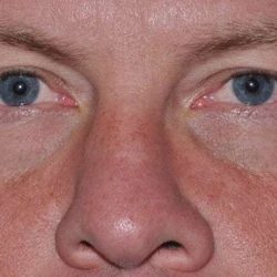 Blepharoplasty (Eyelid Surgery) Before & After Patient #4574