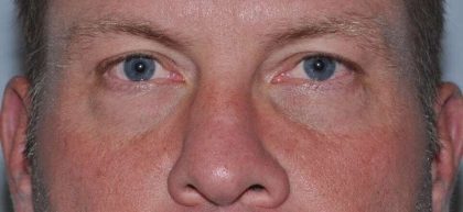 Blepharoplasty (Eyelid Surgery) Before & After Patient #4574