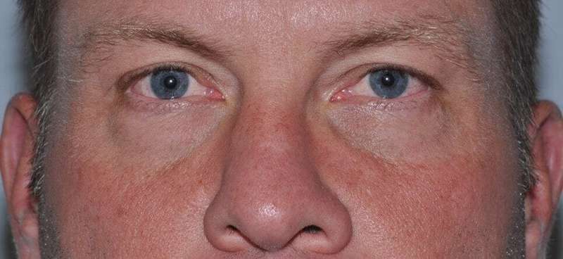 Blepharoplasty (Eyelid Surgery) Before & After Patient #4574