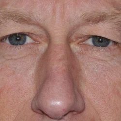 Blepharoplasty (Eyelid Surgery) Before & After Patient #4581