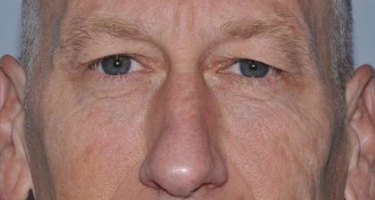 Blepharoplasty (Eyelid Surgery) Before & After Patient #4581