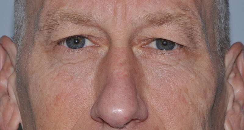 Blepharoplasty (Eyelid Surgery) Before & After Patient #4581