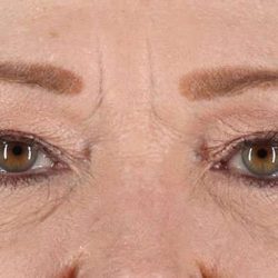 Blepharoplasty (Eyelid Surgery) Before & After Patient #4588