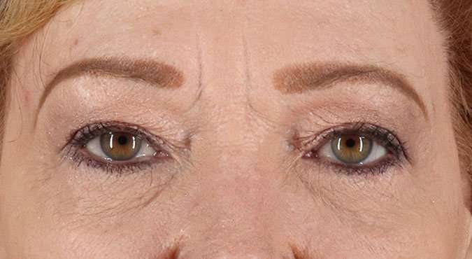 Blepharoplasty (Eyelid Surgery) Before & After Patient #4588