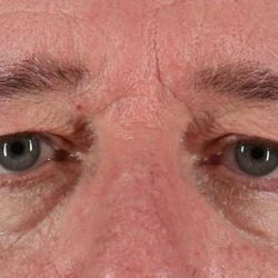 Blepharoplasty (Eyelid Surgery) Before & After Patient #4599