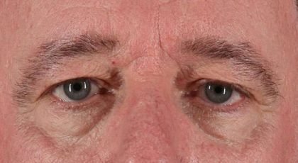 Blepharoplasty (Eyelid Surgery) Before & After Patient #4599