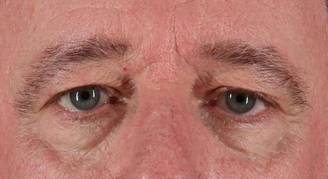 Blepharoplasty (Eyelid Surgery) Before & After Patient #4599