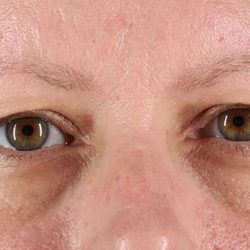 Blepharoplasty (Eyelid Surgery) Before & After Patient #4602