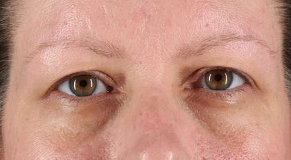 Blepharoplasty (Eyelid Surgery) Before & After Patient #4602