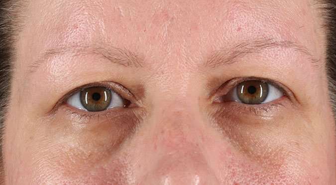 Blepharoplasty (Eyelid Surgery) Before & After Patient #4602