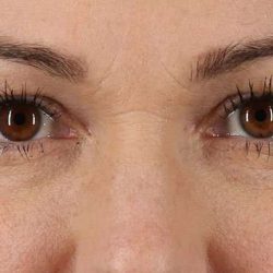 Blepharoplasty (Eyelid Surgery) Before & After Patient #4605