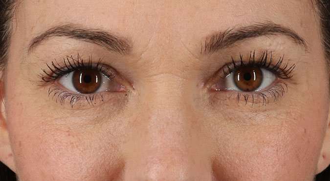 Blepharoplasty (Eyelid Surgery) Before & After Patient #4605