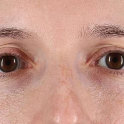 Blepharoplasty (Eyelid Surgery) Before & After Patient #4608
