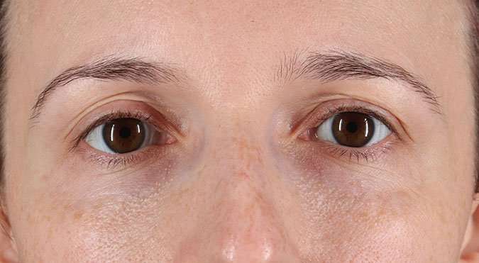 Blepharoplasty (Eyelid Surgery) Before & After Patient #4608