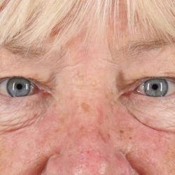 Blepharoplasty (Eyelid Surgery) Before & After Patient #4611