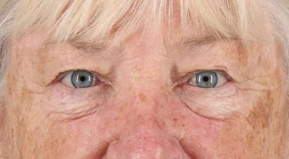 Blepharoplasty (Eyelid Surgery) Before & After Patient #4611