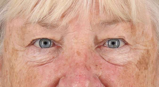 Blepharoplasty (Eyelid Surgery) Before & After Patient #4611