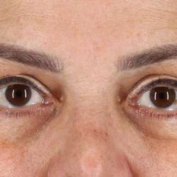 Blepharoplasty (Eyelid Surgery) Before & After Patient #4614