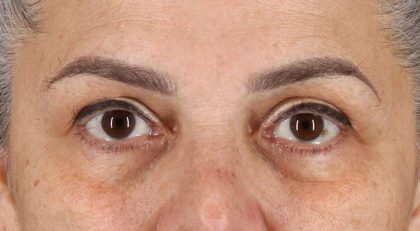 Blepharoplasty (Eyelid Surgery) Before & After Patient #4614