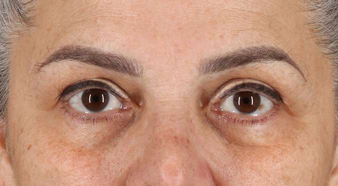 Blepharoplasty (Eyelid Surgery) Before & After Patient #4614