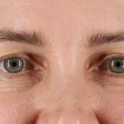 Blepharoplasty (Eyelid Surgery) Before & After Patient #4617
