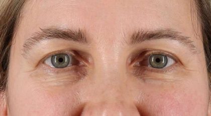 Blepharoplasty (Eyelid Surgery) Before & After Patient #4617