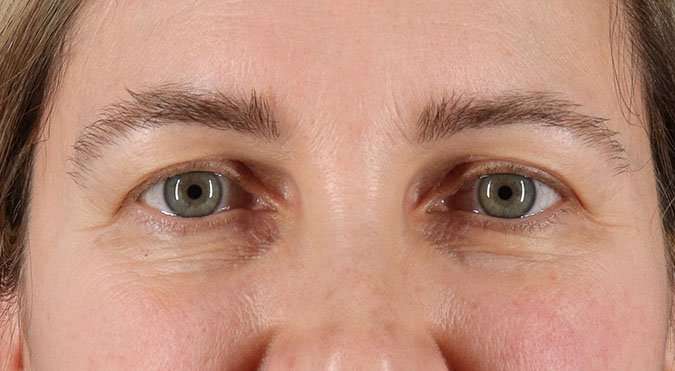 Blepharoplasty (Eyelid Surgery) Before & After Patient #4617