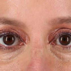Blepharoplasty (Eyelid Surgery) Before & After Patient #4620