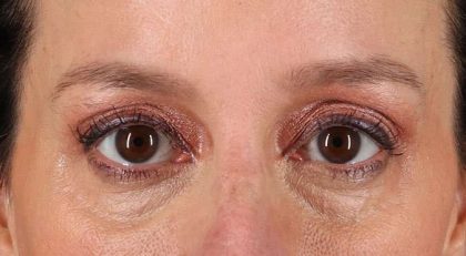 Blepharoplasty (Eyelid Surgery) Before & After Patient #4620