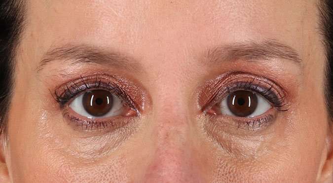 Blepharoplasty (Eyelid Surgery) Before & After Patient #4620