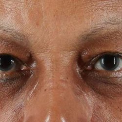Blepharoplasty (Eyelid Surgery) Before & After Patient #4623
