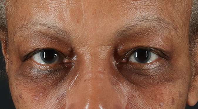 Blepharoplasty (Eyelid Surgery) Before & After Patient #4623